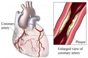 enlarged-view-of-coronary-artery-with-plaque-formation